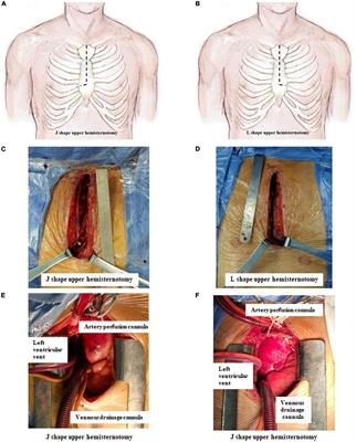 Both J- and L-shaped upper hemisternotomy approaches are suitable for total arch replacement with frozen elephant trunk in patients with Type A dissection